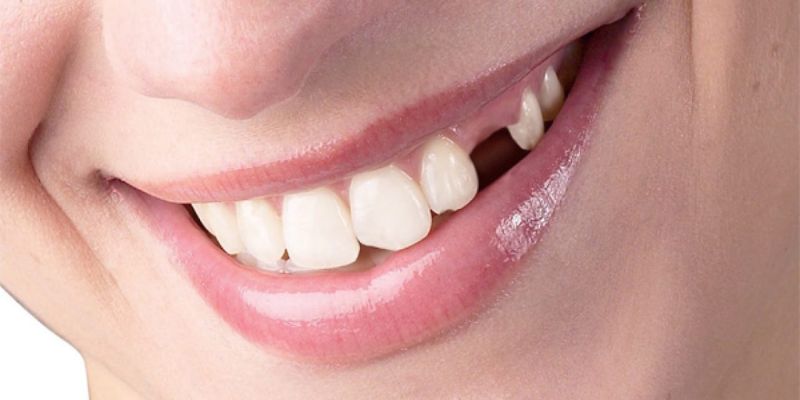 Mơ rụng răng một chiếc nhưng tiền bạc chảy về như suối